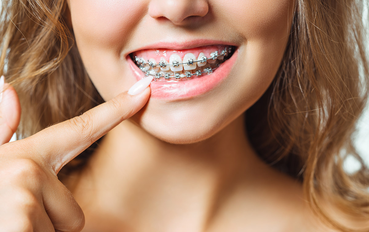 Aparat ortodontyczny na proste zęby?